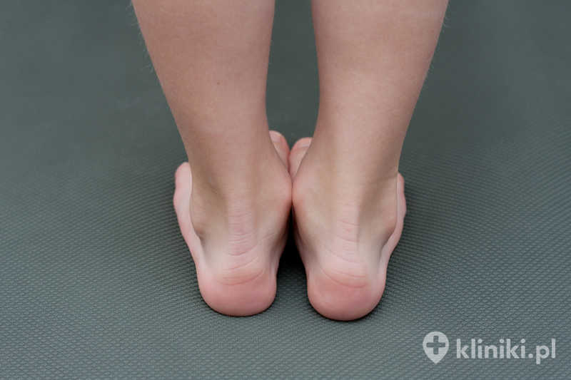 Operacja stopy płasko-koślawej zwykle obejmuje korekcję ustawienia kości piętowej, rekonstrukcję więzadeł lub wydłużenie ścięgna, w zależności od nasilenia deformacji