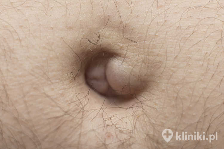 Operacyjne leczenie przepukliny brzusznej zapobiega groźnym powikłaniom, takim jak uwięźnięcie jelita