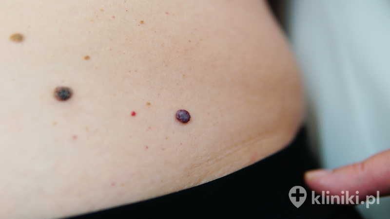 Przyczyny naczyniaków