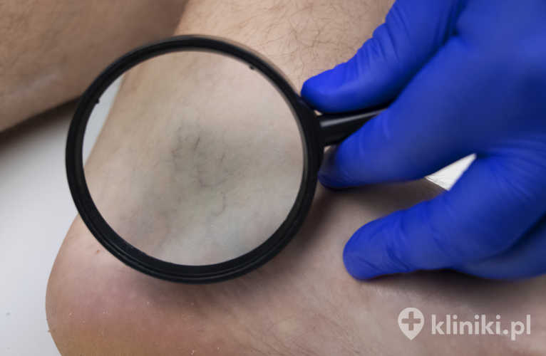 Przyczyny owrzodzeń żylnych