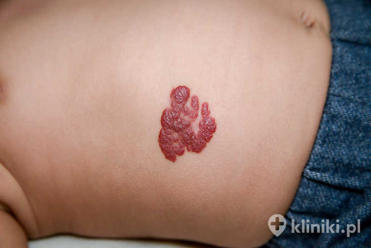 Usuwanie naczyniaków