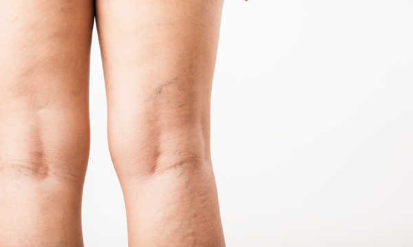 Użycie oświetlacza naczyniowego przy skleroterapii poprawia widoczność drobnych i głębiej położonych naczynek