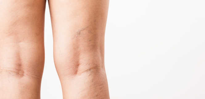 Użycie oświetlacza naczyniowego przy skleroterapii