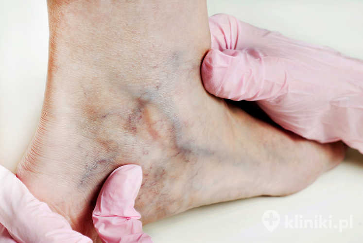 Użycie oświetlacza naczyniowego przy skleroterapii zwiększa precyzję wkłucia i podania środka obliterującego