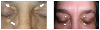 Dermatochirurgia przed i po zabiegu