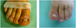 Drobne zabiegi chirurgiczne przed i po zabiegu