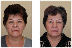 Lifting operacyjny przed i po zabiegu