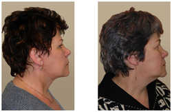 Lifting operacyjny przed i po zabiegu