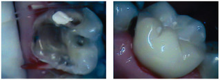 Odbudowa zęba kompozytem przed i po zabiegu