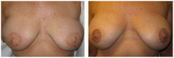 Rekonstrukcja otoczki brodawki sutkowej - pigmentacja medyczna przed i po zabiegu