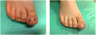 Usunięcie wrastającego paznokcia chirurgicznie przed i po zabiegu