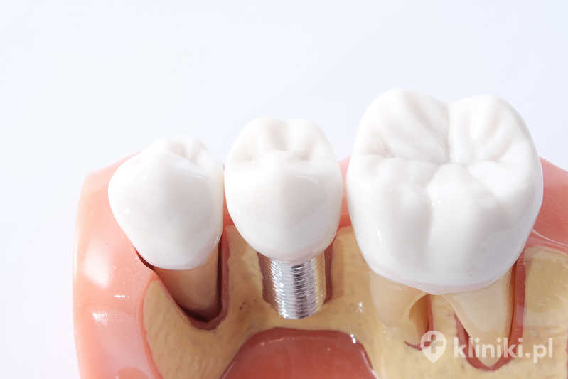 Miniimplanty umożliwiają szybkie zakotwiczenie protezy bez konieczności rozległego zabiegu chirurgicznego Miniimplanty umożliwiają szybkie zakotwiczenie protezy bez konieczności rozległego zabiegu chirurgicznego