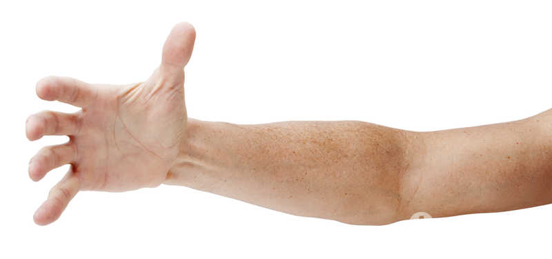 Neurorehabilitacja ręki