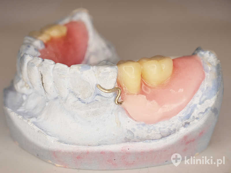 Proteza szkieletowa metalowa zwykle posiada precyzyjne klamry lub zatrzaski, które poprawiają komfort użytkowania Proteza szkieletowa metalowa zwykle posiada precyzyjne klamry lub zatrzaski, które poprawiają komfort użytkowania