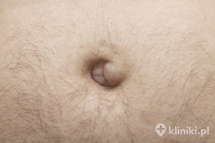 Ból przepukliny może promieniować do pachwiny, uda lub podbrzusza, w zależności od jej lokalizacji.