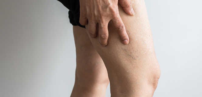 Jak zapobiegać żylakom nóg