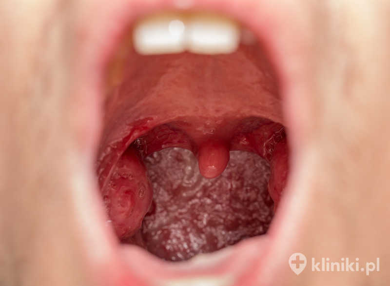 Koblacja migdałków sprzyja szybszej rekonwalescencji, ponieważ redukuje ból pooperacyjny u wielu pacjentów Koblacja migdałków sprzyja szybszej rekonwalescencji, ponieważ redukuje ból pooperacyjny u wielu pacjentów