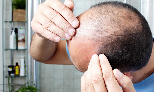 Leczenie łysienia niechirurgicznymi implantami włosów