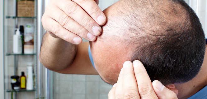 Leczenie łysienia niechirurgicznymi implantami włosów PHP Medical - bezpłatne konsultacje