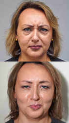 Linie pionowe czoła (lwia zmarszczka) - usuwanie zmarszczek toksyną botulinową przed i po zabiegu