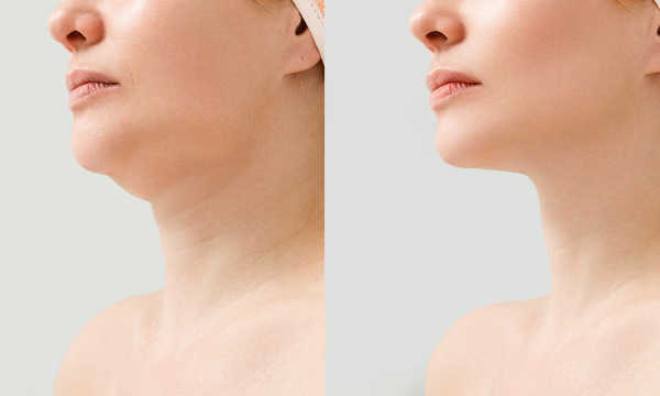 Lipofilling w technologii Lipogems pozwala uzyskać naturalny efekt wypełnienia przy jednoczesnym działaniu regeneracyjnym