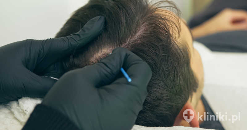 Mikropigmentacja skóry głowy