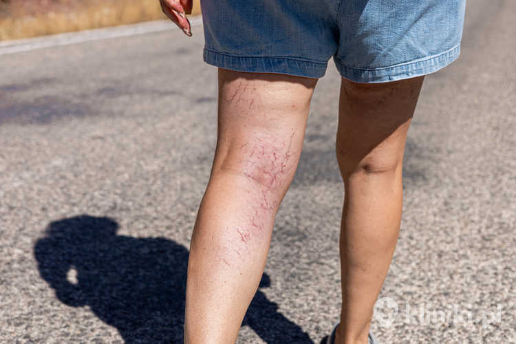 Operacja żylaków w przebiegu zespołu pozakrzepowego może zmniejszyć obrzęki, ból i nasilenie zmian skórnych