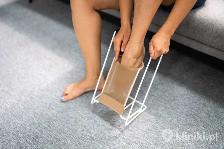 Wyroby uciskowe w profilaktyce żylaków nóg wspierają pracę zastawek żylnych, ograniczając cofanie się krwi