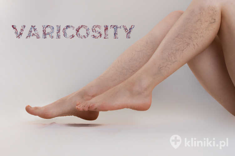 Zalety leczenia żylaków prądem o wysokiej częstotliwości wynikają z precyzyjnego zamykania niewydolnych żył bez dużych nacięć