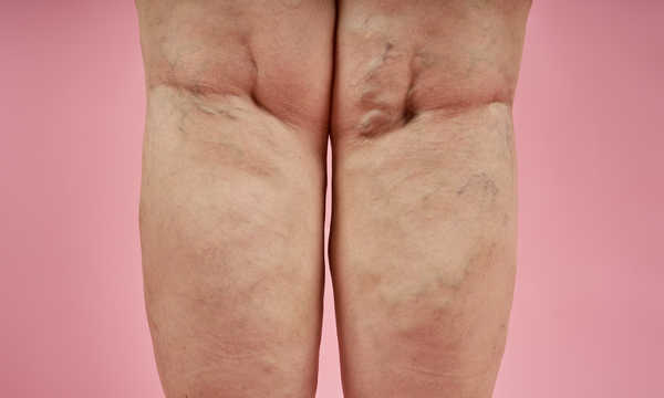 żylaki kończyn dolnych