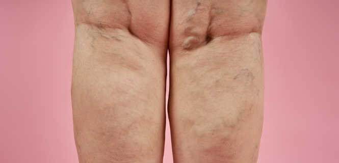 Co to są żylaki kończyn dolnych?