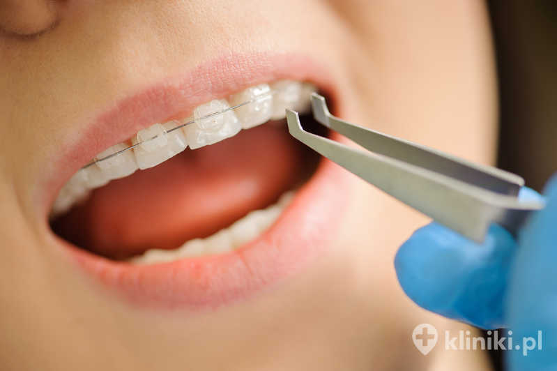 Aparat ortodontyczny stały – Iconix jest łatwiejszy w utrzymaniu czystości, co pomaga w dbaniu o higienę jamy ustnej podczas leczenia