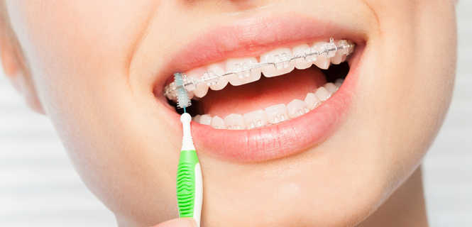 Aparat ortodontyczny stały – Iconix