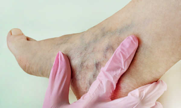 Czy wszystkie żylaki nóg da się wyleczyć laserem?