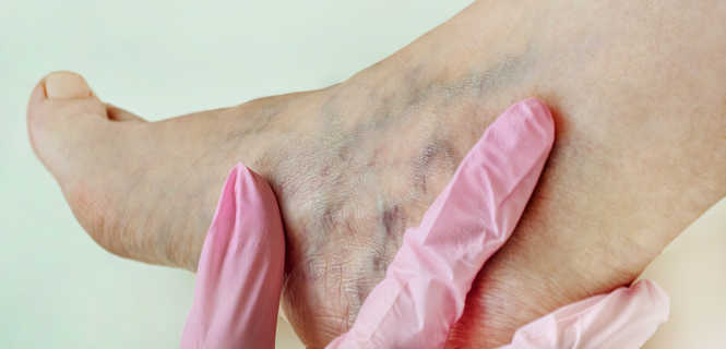 Czy wszystkie żylaki nóg da się wyleczyć laserem?