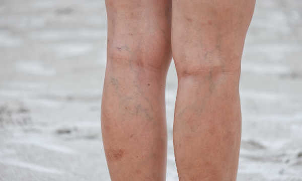 Kliniki.pl Wiedza o zdrowiu Chirurgia naczyniowa i flebologia Zalecenia po zabiegu miniflebektomii żylaków na nogach
Zalecenia po zabiegu miniflebektomii żylaków na nogach