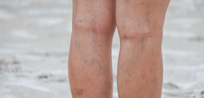 Zalecenia po zabiegu miniflebektomii żylaków na nogach