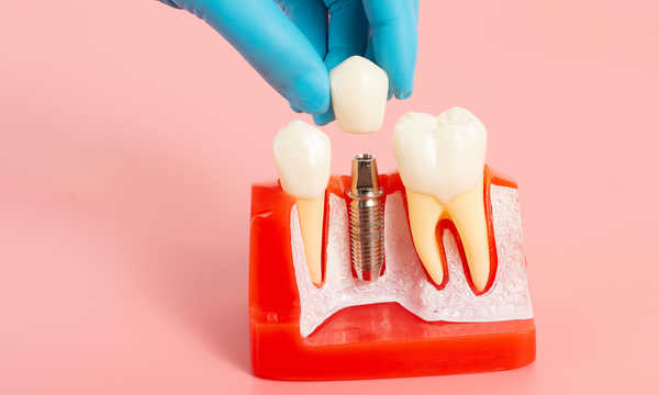 Korona porcelanowa pozwala odbudować zniszczony ząb przy zachowaniu naturalnego koloru i kształtu Korona porcelanowa pozwala odbudować zniszczony ząb przy zachowaniu naturalnego koloru i kształtu