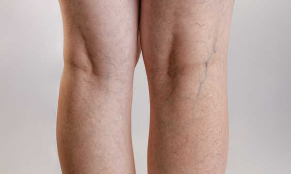 Kriostrippng jako metoda leczenia żylaków kończyn dolnych