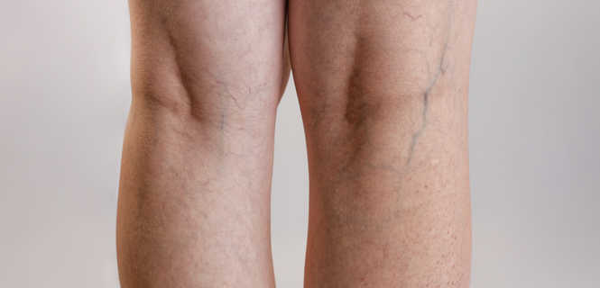 Kriostrippng jako metoda leczenia żylaków kończyn dolnych