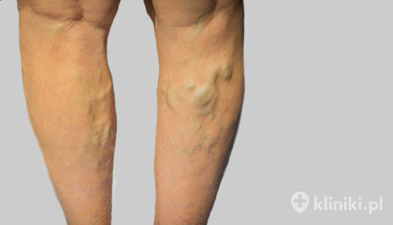 Kwalifikacja pacjentów do leczenia Flebogrif