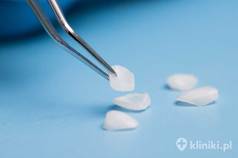 Licówka porcelanowa ultracienka pozwala skorygować przebarwienia, drobne pęknięcia oraz niewielkie nierówności zębów