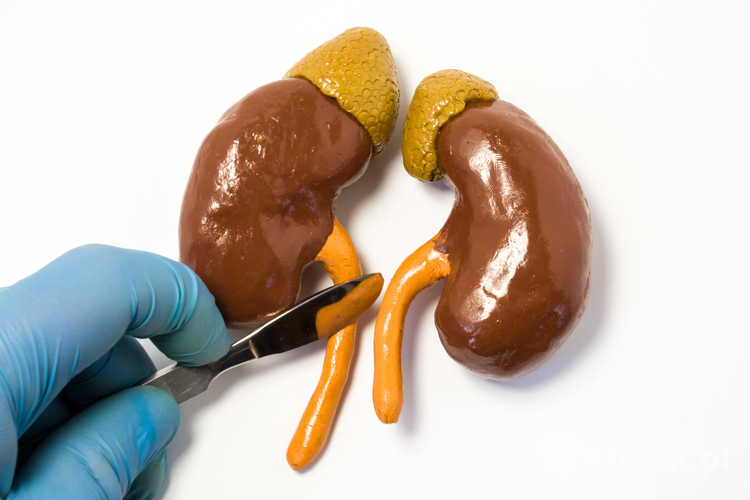 Objawy kamicy moczowodowej