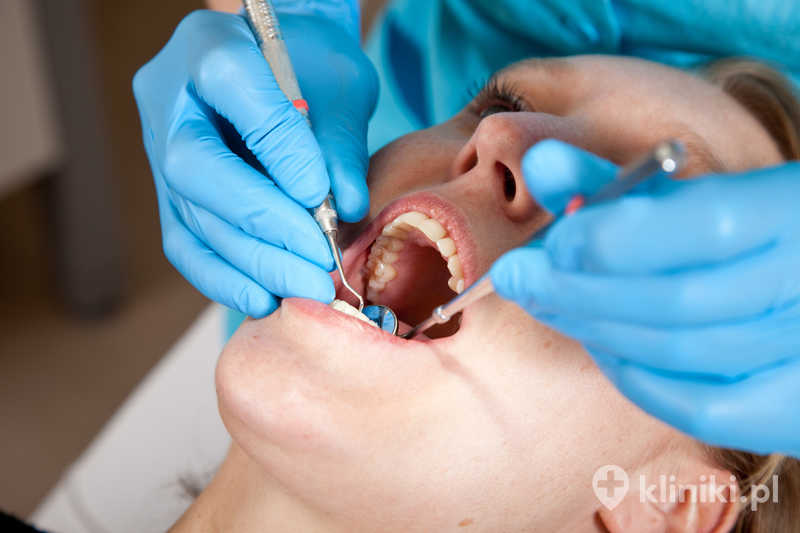 Powtórne leczenie kanałowe pod mikroskopem jest szczególnie przydatne przy niestandardowej anatomii korzeni, zwężeniach lub perforacjach Powtórne leczenie kanałowe pod mikroskopem jest szczególnie przydatne przy niestandardowej anatomii korzeni, zwężeniach lub perforacjach