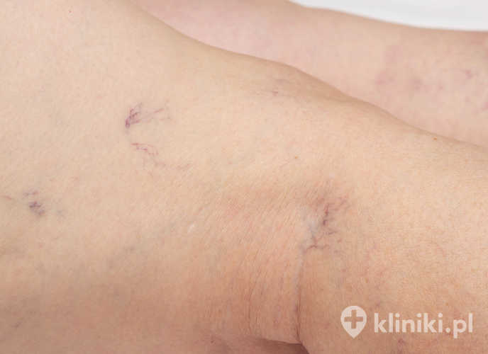 Przyczyny pajączków na nogach