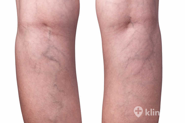 Skuteczność leczenia żylaków klejem wewnątrznaczyniowym