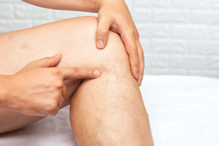 Żylaki kończyn dolnych