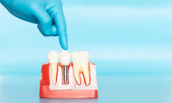 Implanty jednofazowe to jednoczęściowe implanty stomatologiczne, w których część wszczepiana w kość i element protetyczny stanowią jedną całość