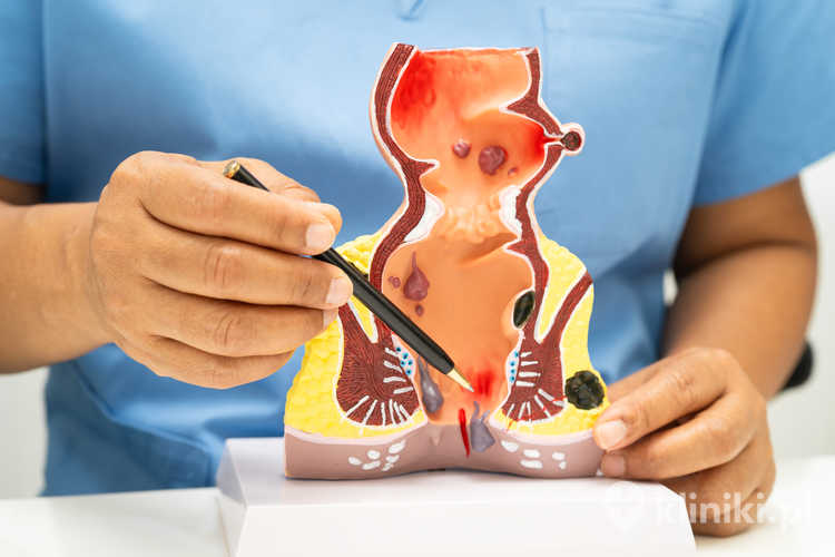 Laserowe leczenie hemoroidów pozwala na precyzyjne zamknięcie zmienionych naczyń przy minimalnym uszkodzeniu otaczających tkanek