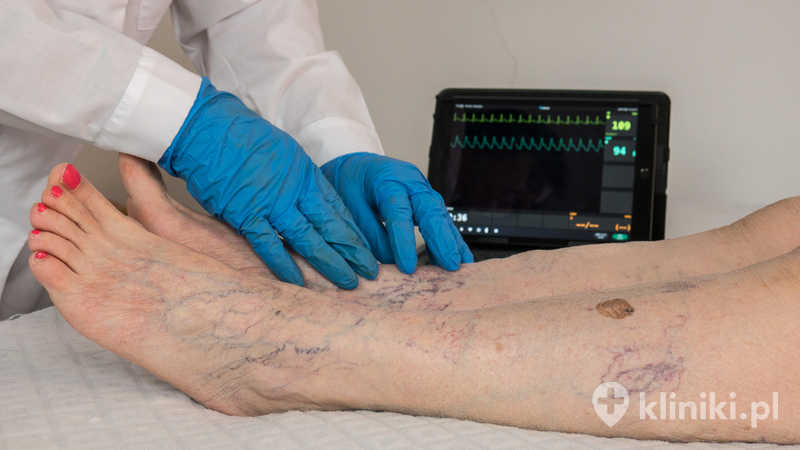 Laserowe usuwanie żylaków